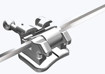 自鎖托槽矯正牙齒的價(jia) 格