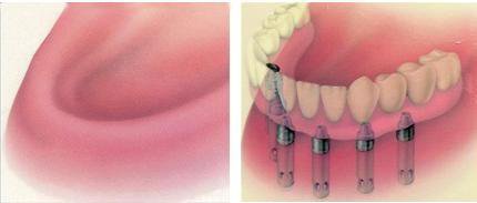 全口牙缺失做種植牙