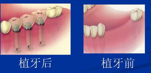 顆種植牙的步驟