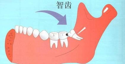 拔智齒多少錢能用醫保嗎