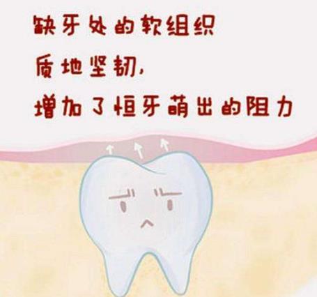恒牙遲萌的原因