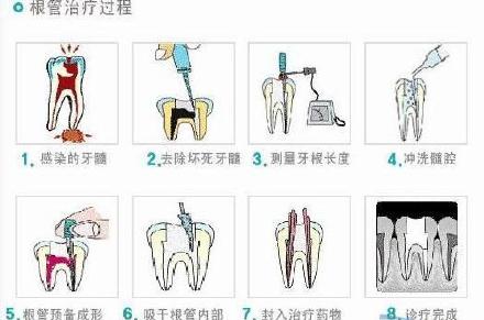 根管治療有什麽(me) 作用
