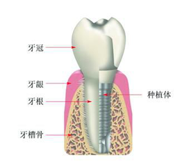 種一顆牙齒的費用