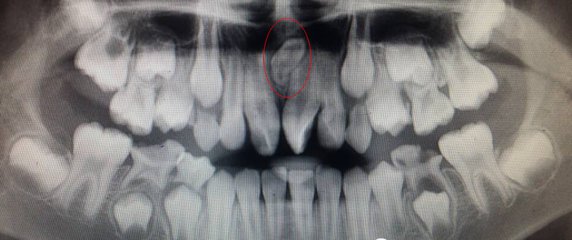 兒(er) 童牙科拔牙價(jia) 格