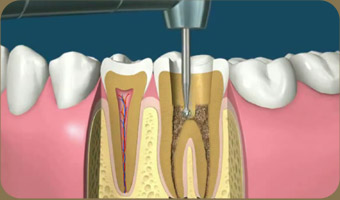牙髓炎治療價(jia) 格