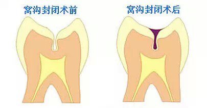 窩溝封閉的費用