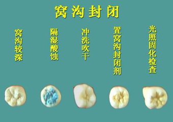 窩溝封閉的過程