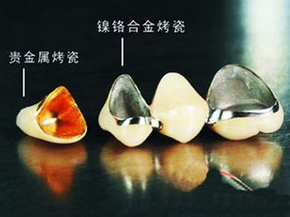 貴金屬烤瓷牙多少錢