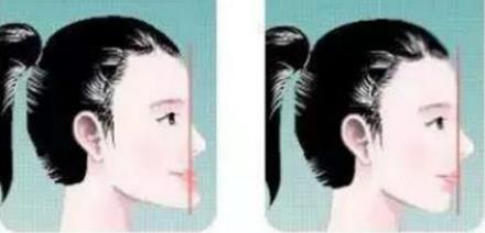 地包天不矯正的危害