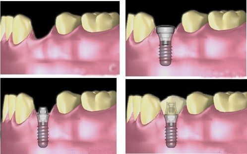 種植牙需要什麽(me) 條件