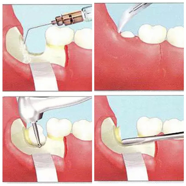 拔完智齒能吃飯嗎