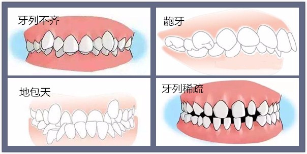 兒(er) 童齙牙什麽(me) 時候矯正