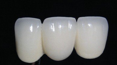 一顆烤瓷牙多少錢