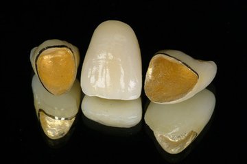 一顆烤瓷牙的價(jia) 格