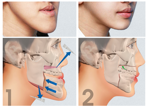 地包天是什麽(me) 意思