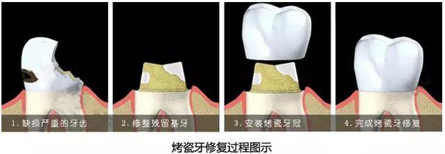  烤瓷牙換一顆牙齒要多少錢