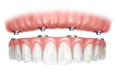 全口牙種植多少錢