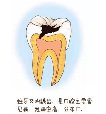 牙齒有洞可以補牙