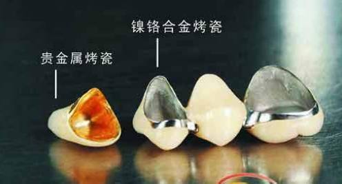 烤瓷牙的價(jia) 格