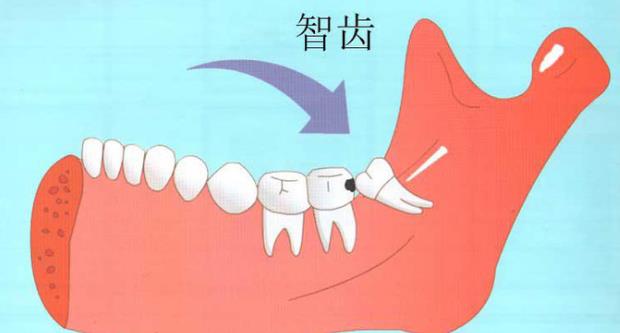 拔智齒大家擔心的危害