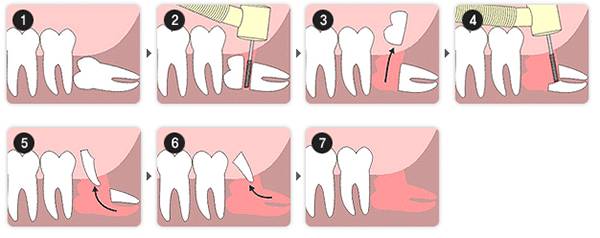 智齒是這樣拔的，沒有危害