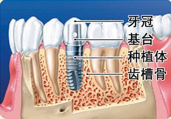 種植滿口牙多少錢