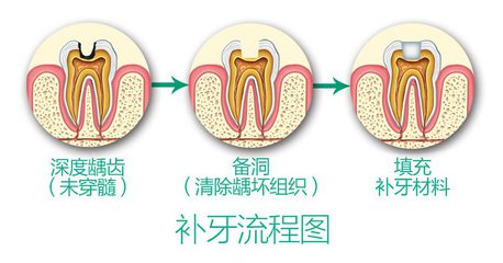 補牙過程圖