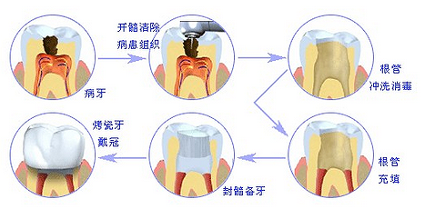 根管治療步驟