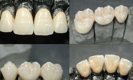 烤瓷牙的價(jia) 格