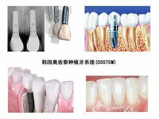 韓國奧齒泰種植牙修複結果
