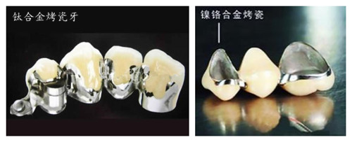 孕期可以做烤瓷牙嗎