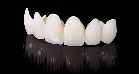 一顆全瓷牙要多少錢