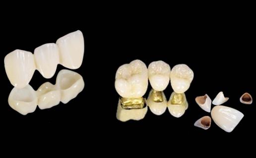 烤瓷牙對牙齒有影響嗎