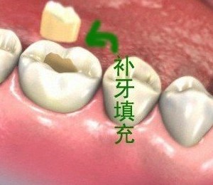 補牙多少錢