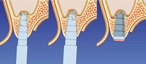 種植牙上頜竇手術