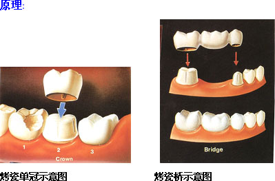 烤瓷牙假牙修複