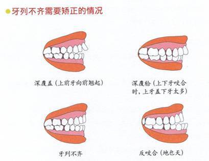 牙齒不齊矯正