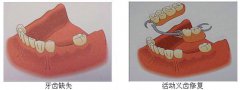 假牙價格表