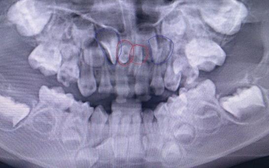 兒(er) 童多生牙拔除多少錢