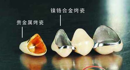 烤瓷牙種類