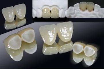 全瓷牙修複結果