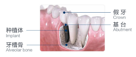 種植牙的結構