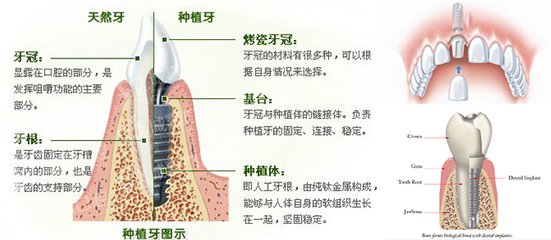 種植牙結構介紹
