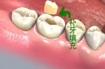 牙齒爛掉補牙