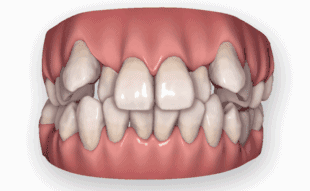 牙齒矯正可以用醫保嗎