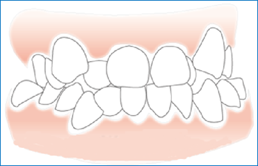 牙齒擁擠矯正