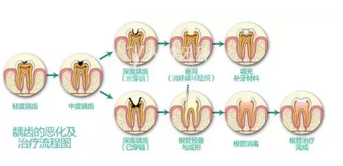 補牙需要多長時間
