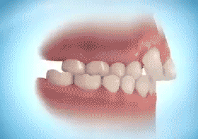 牙齒矯正擴弓器