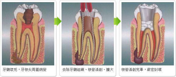 蛀牙根管治療