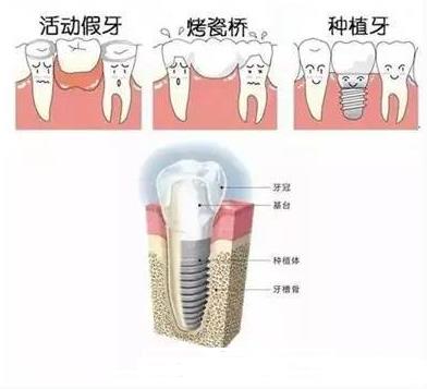 鑲牙需要多久時間